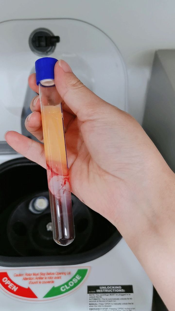 Platelet-Rich Plasma PRP treatment procedure at Klinik Tong & Surgeri