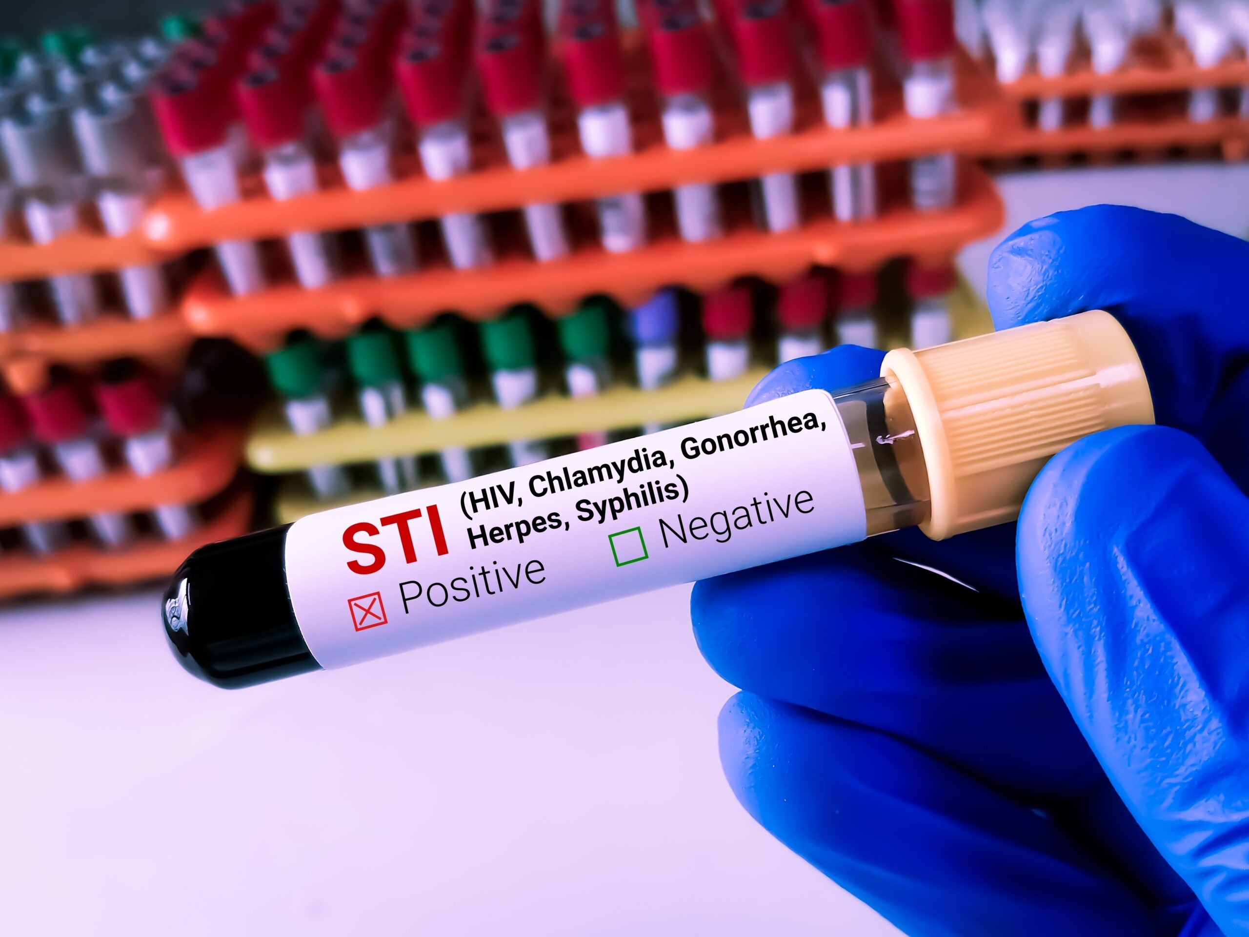 STI screening sample for confidential sexually transmitted disease testing